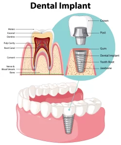 dental implant